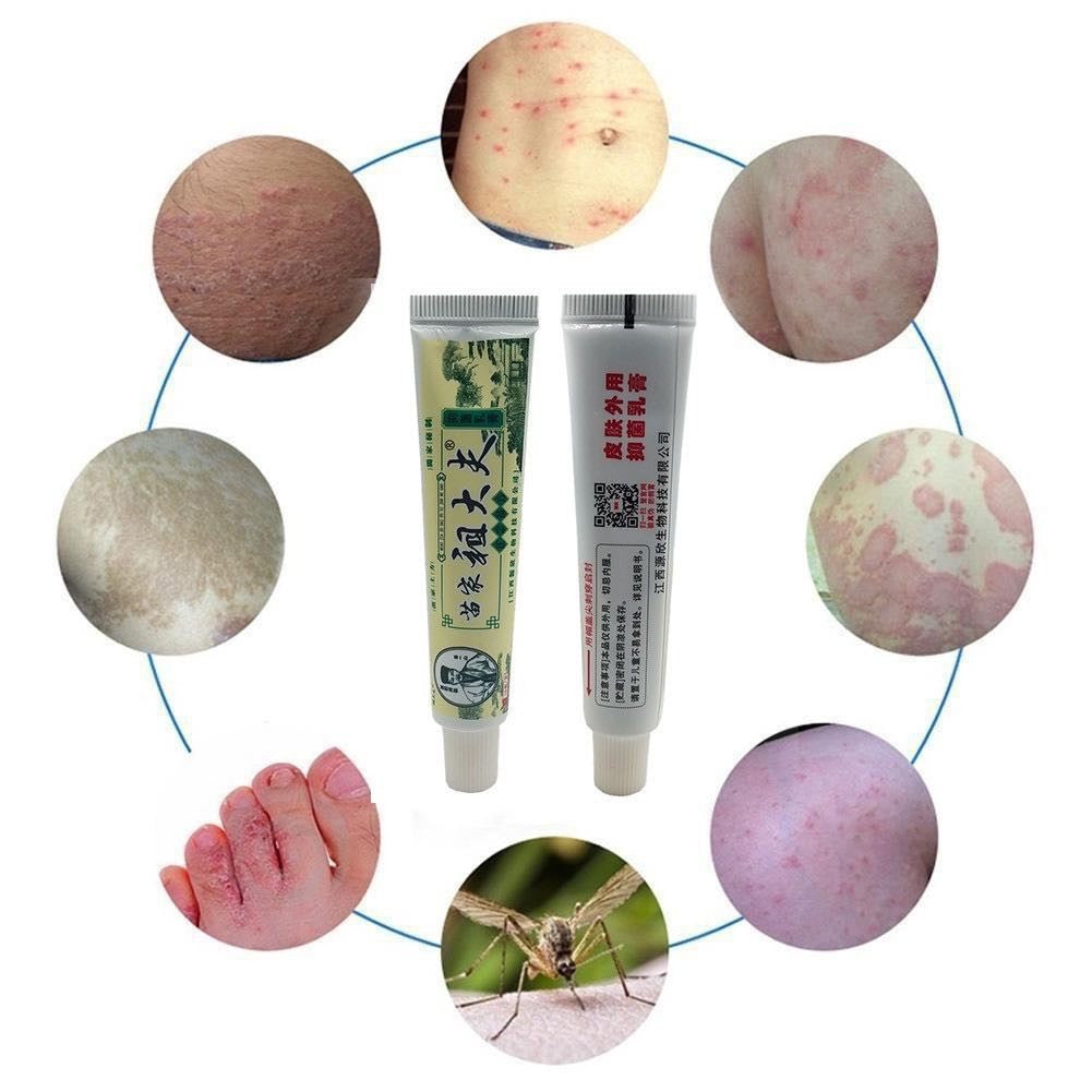 Zudaifu Chinese Herbal Skin Psoriasis Cream (Dermatitis, Eczematoid & Eczema)